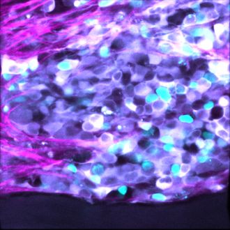 Neuroblastoma cells and the surrounding collagen matrix.