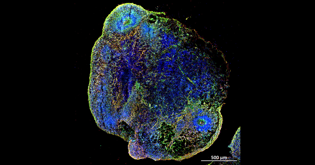 Researchers at UQ's Australian Institute for Bioengineering and Nanotechnology used synthetic brain organoid models, grown in a laboratory from human stem cells, to explore ways of turning back the ageing affect of COVID-19. 