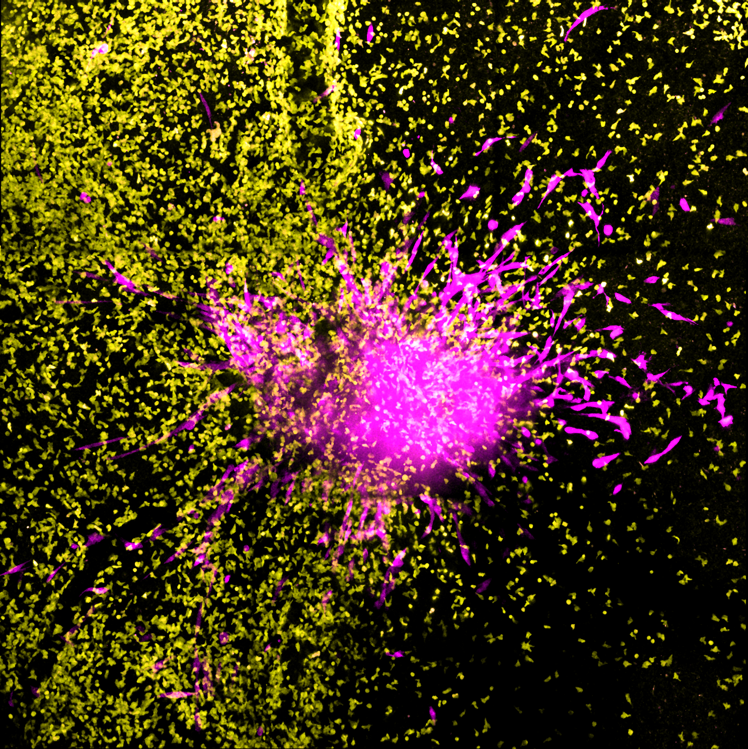 Chimeric Antigen Receptor (CAR) T cells, genetically engineered leukocytes (white blood cells), in their fight against glioblastoma, a deadly type of glioma. Credit: WEHI 