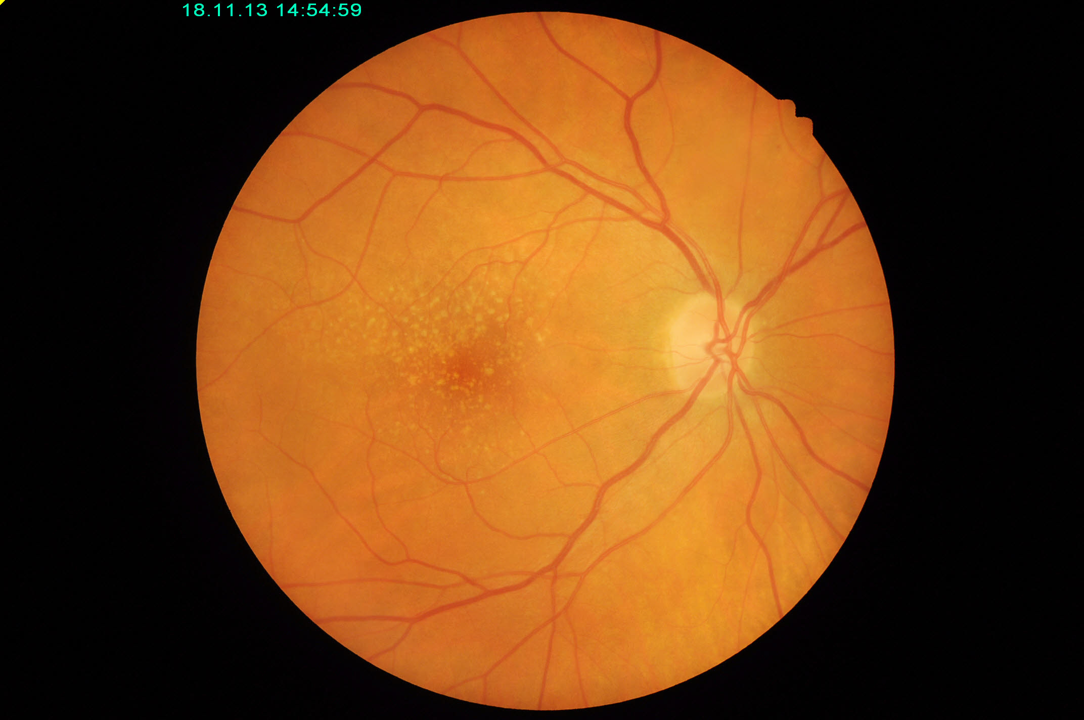 Small lumps in this image indicate macular degeneration. Photo: Lisa Nivison-Smith