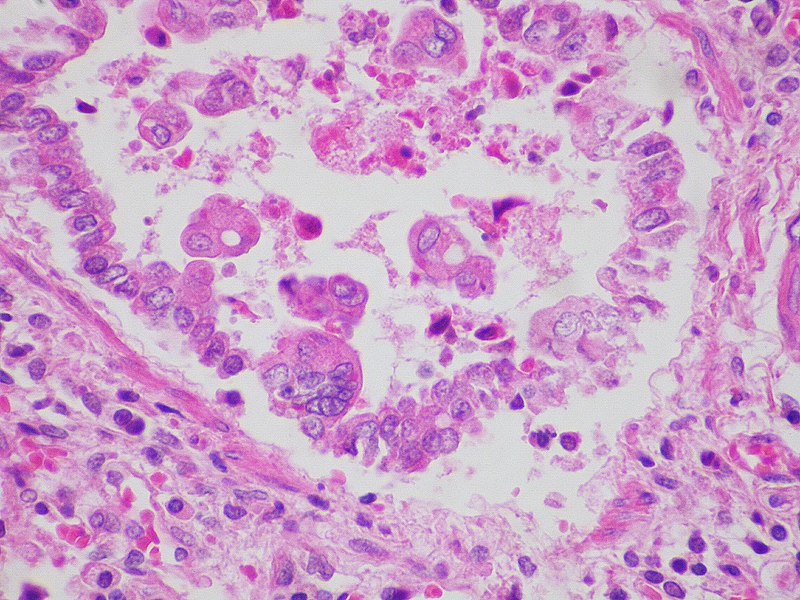 Respiratory_syncytial_virus_(RSV)_infection_x400 By - Yale Rosen collection, CC BY-SA 2.0