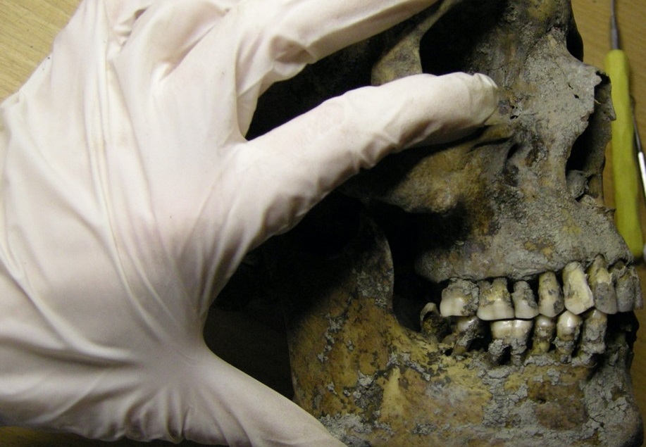 Examination of Viking jaw and teeth. CREDIT: Carolina Bertilsson, CC-BY 4.0 (https://creativecommons.org/licenses/by/4.0/)