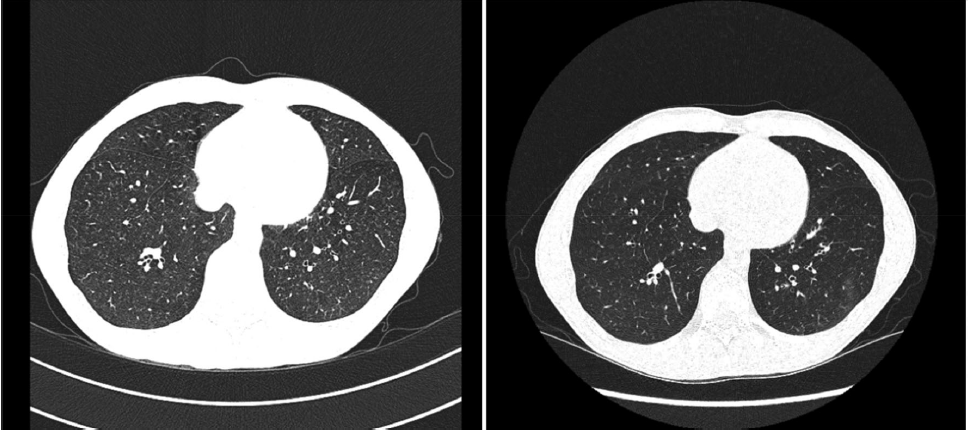 Pre-procedure images (left) demonstrate diffuse semi-solid centrilobular nodules that were present throughout both lungs. Post-procedure images (right) demonstrate significant clearing. Credit: D.C Chambers et al.
