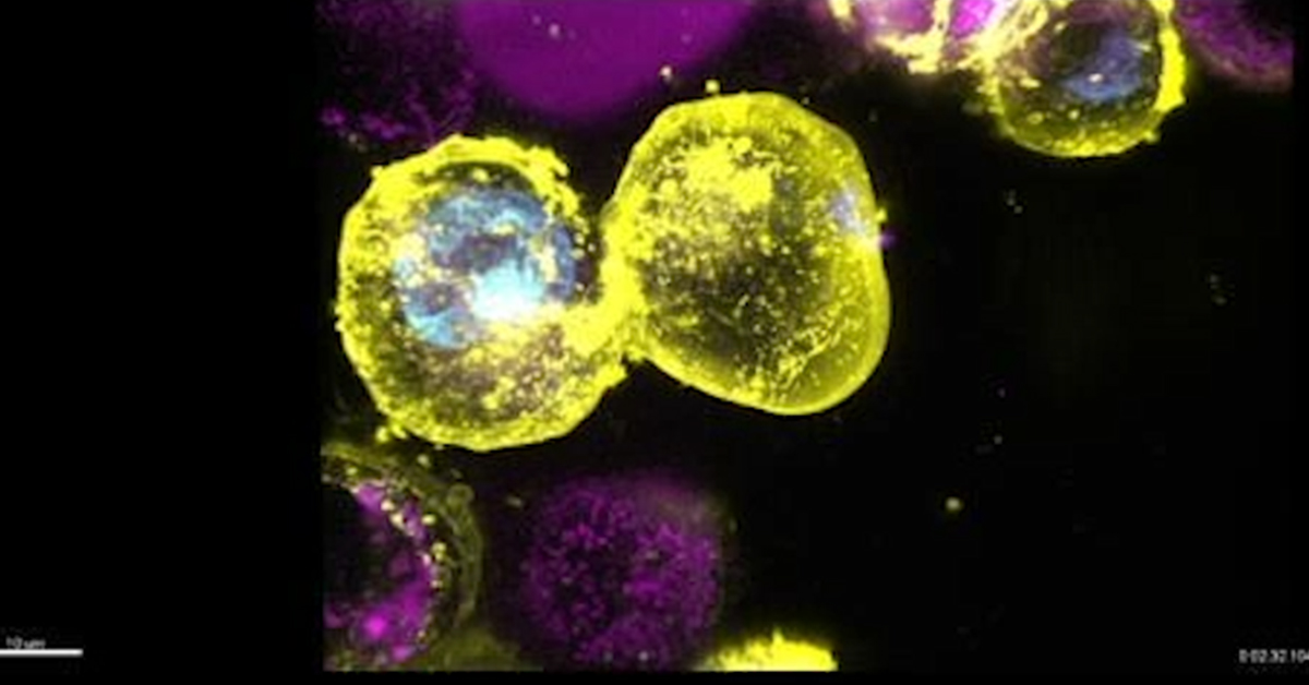 Cells dying by necroptosis, an inflammatory form of cell death which is driven by the protein MLKL. Credit: WEHI