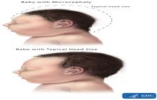Microcephaly and Typical Head Size Comparison